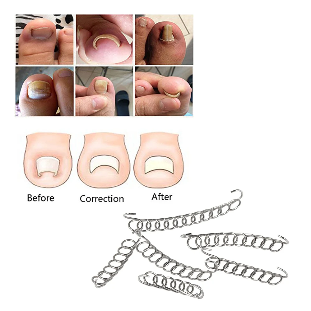 

12Pcs Ingrown Toenail Correction Wire Fixer Ingrown Toe Nail Corrector Pedicure Treatment Foot Care Tools massage massager