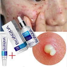 Травяной очищающий гель для лица, крем для лечения прыщей, набор, травяное удаление шрамов, жирная кожа, прыщи, пятна, уход за лицом, крем, красота, легко