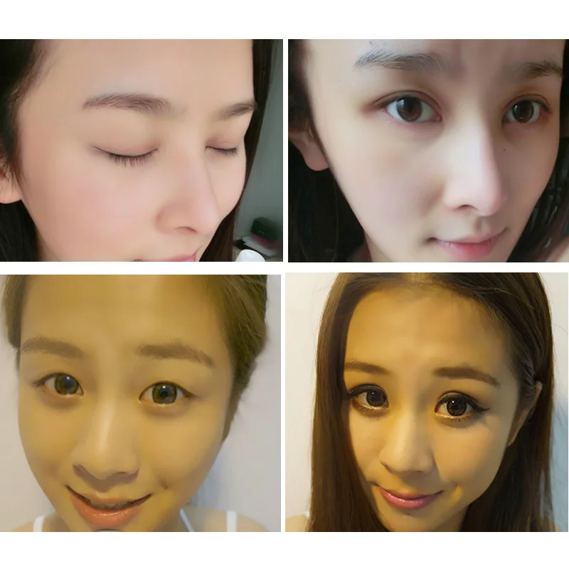 permanent double eyelid
