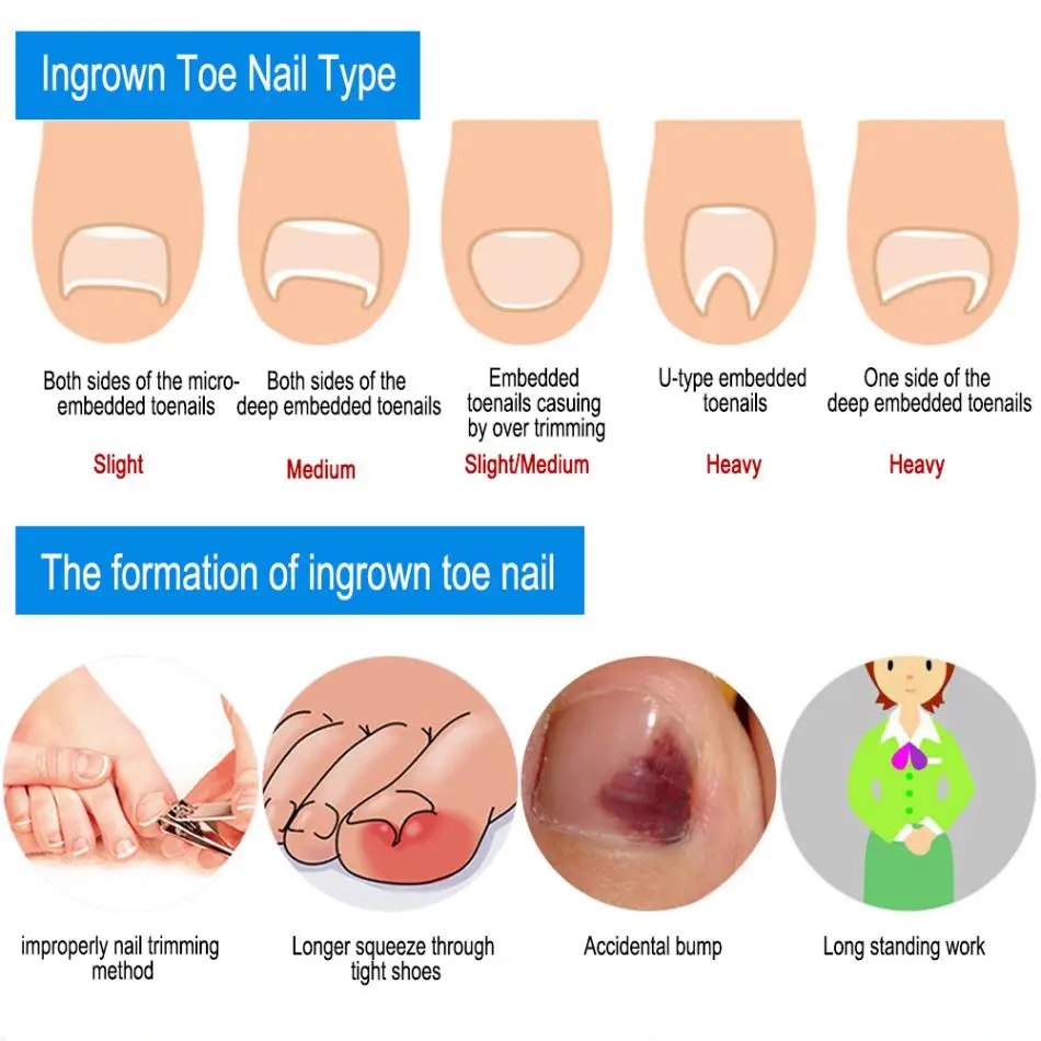 12 шт., инструмент для коррекции вросших ногтей, 6 размеров, фиксатор вросшего пальца, проволока для педикюра, акроникс, ониксис, восстановление пальцев ног, уход за ногами