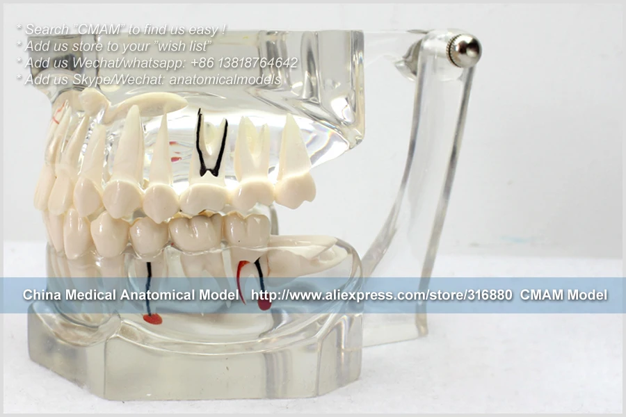 T CMAM/12594 зубоврачебно-патологический Стоматологическая модель, 2X Размер жизни, человек оральный зубные спецодежда медицинская обучение