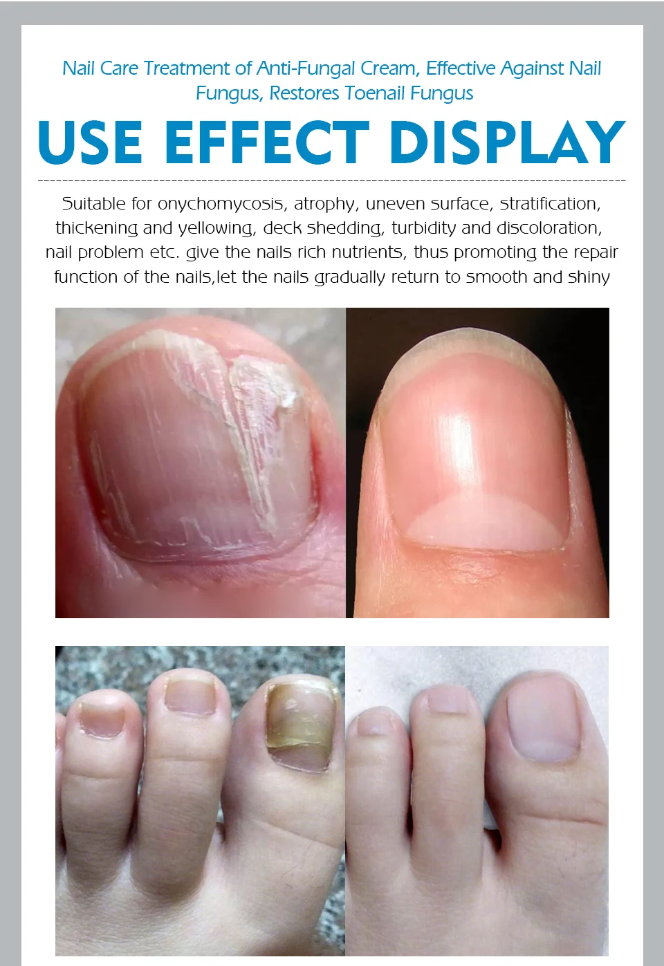 Яркий гламурный крем для восстановления ногтей, Лечение грибка, удаление онихомикоза, против грибок ногтей, крем для ухода за ногтями