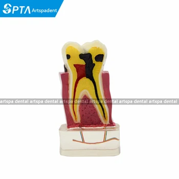 

4:1 Dentist Dental Study Teach Tooth Model Teeth Disease Model
