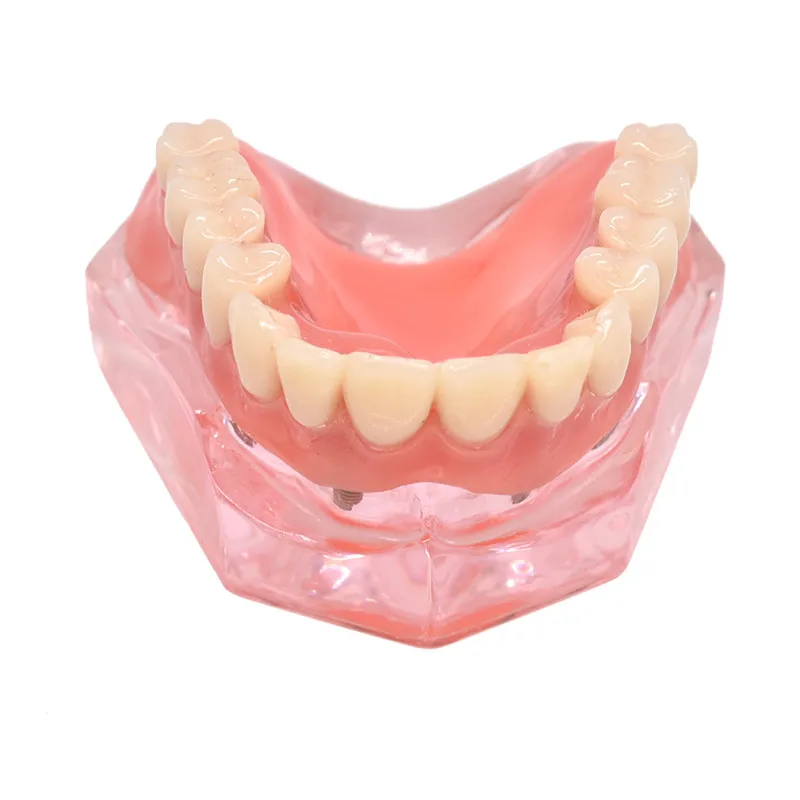 Dental Overdenture Teeth Model Removable Interior Mandibular Lower Teeth Model Mandibular with Implant for Tooth Teaching Study Dental Overdenture Teeth Model Removable Interior Mandibular Lower Teeth Model Mandibular with Implant for Tooth Teaching Study