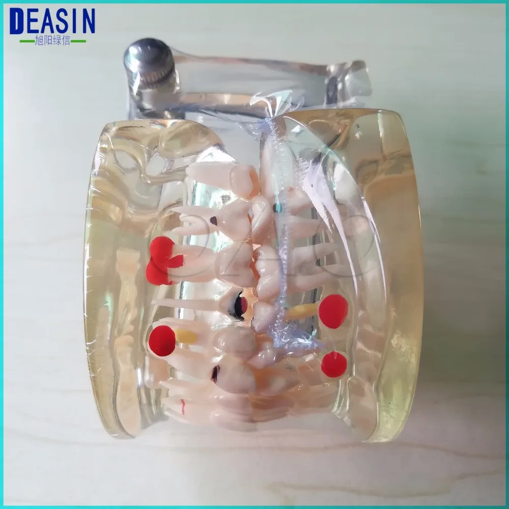 2 PCS Teeth Half side can be removeble model Pathological Model Teaching& Restoration Bridge Tooth Dental Implant Dismantled 2 PCS Teeth Half side can be removeble model Pathological Model Teaching& Restoration Bridge Tooth Dental Implant Dismantled