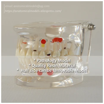

DH/13058, Dental Pathology Half Side Removable Model, Clear Dental Model, Medical Science Educational Teaching Anatomical Models