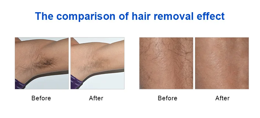 Perfect Portable IPL laser hair removal device 300000 shots Epilator Intense pulsed light Permanent Hair Removal System bikini 5
