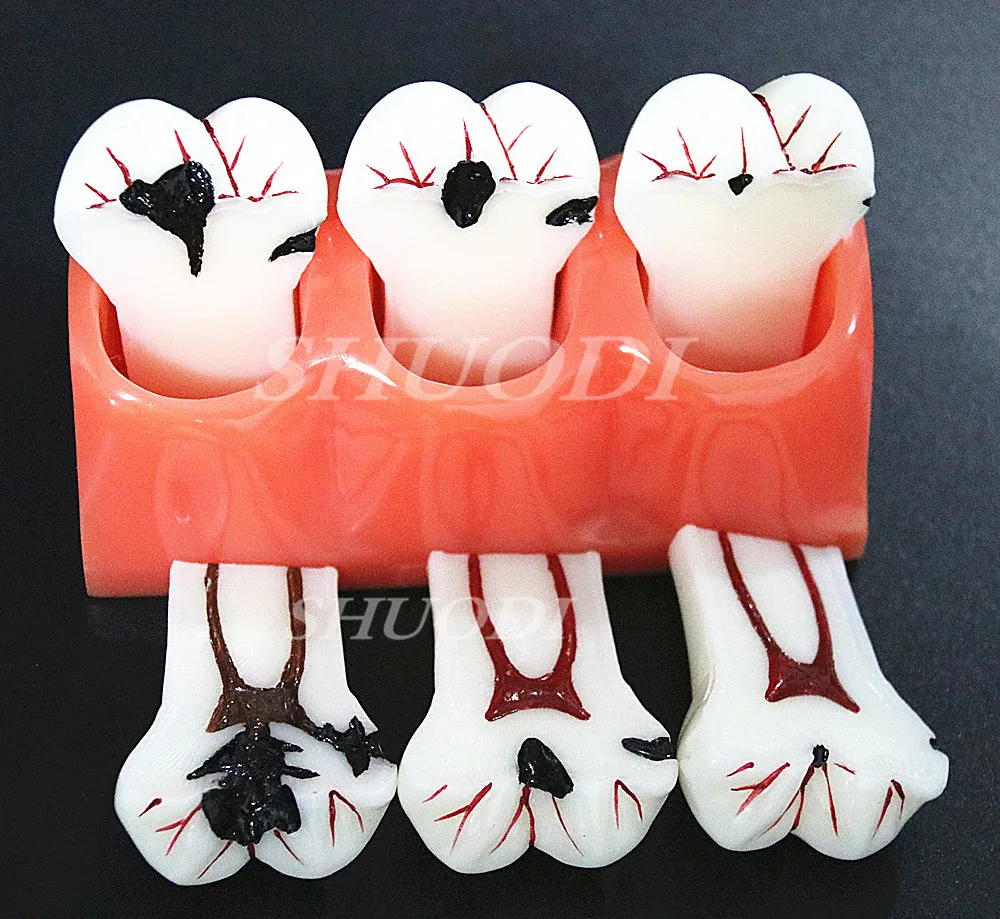 

4 Times Dentist dental caries decomposition model oral pathology dental caries model doctor patient communication demonstration