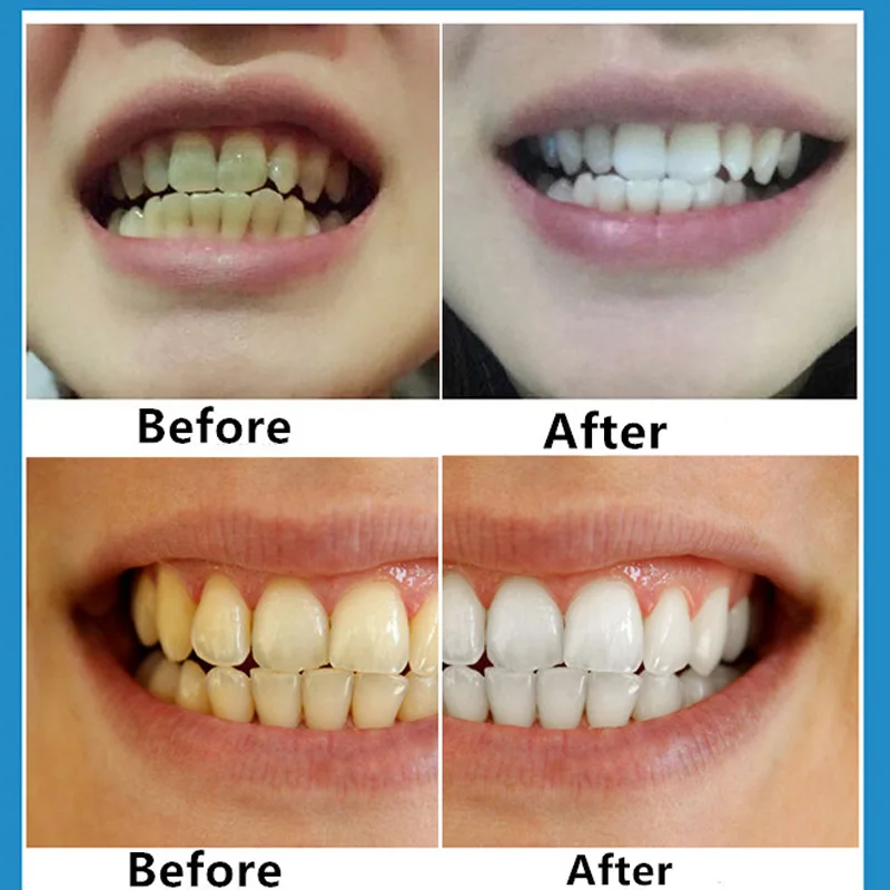 Removing tea Teeth Whitening Liquid Tooth Dental Bleaching Smoke Stain