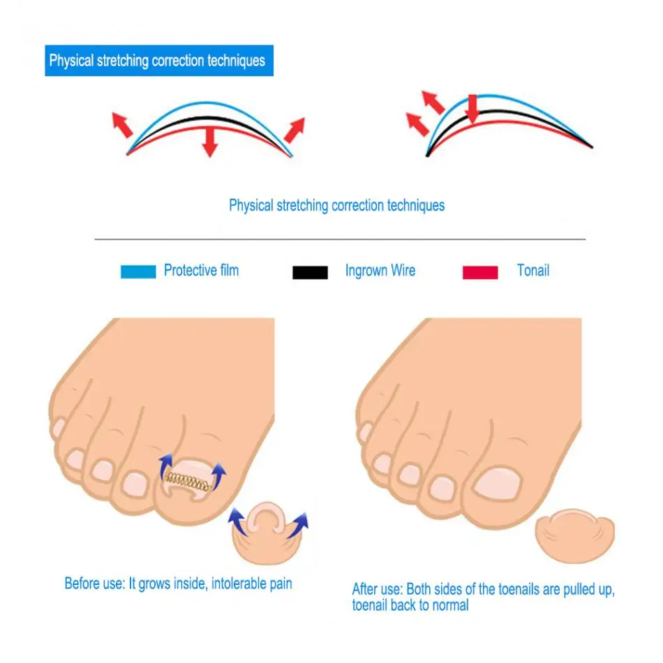12 шт., инструмент для коррекции вросших ногтей, 6 размеров, фиксатор вросшего пальца, проволока для педикюра, акроникс, ониксис, восстановление пальцев ног, уход за ногами
