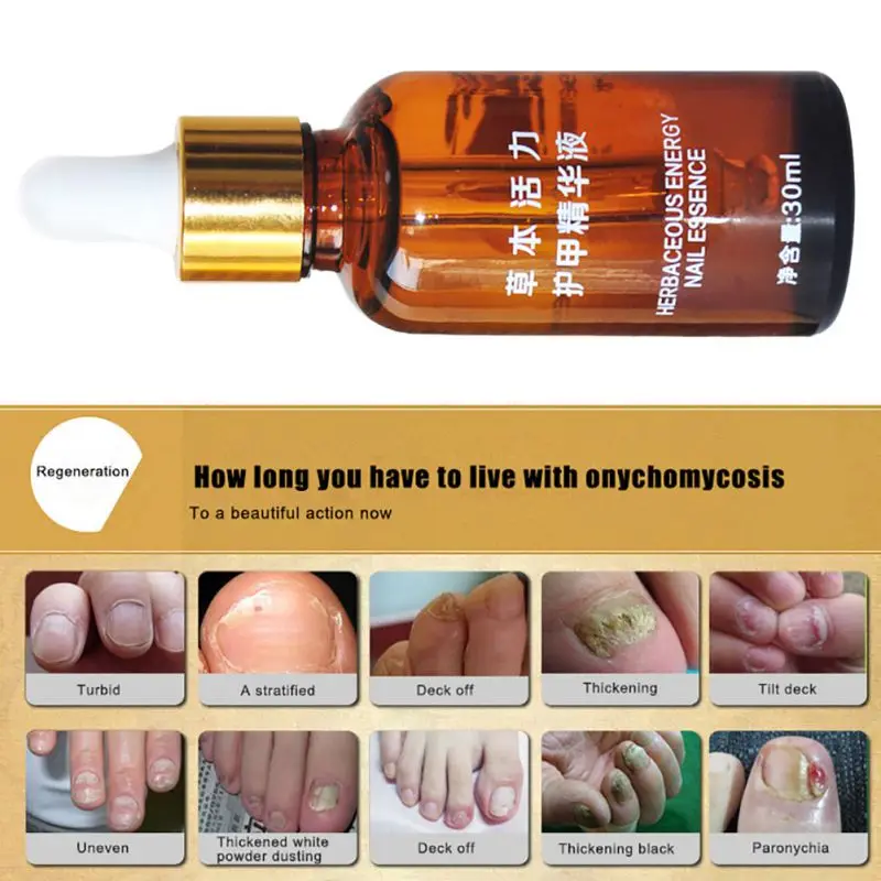 Fungal Nail Treatment Essence Nail and Foot Whitening for Cuticle Oil Toe Nail Fungus Removal Nail Care Makeup