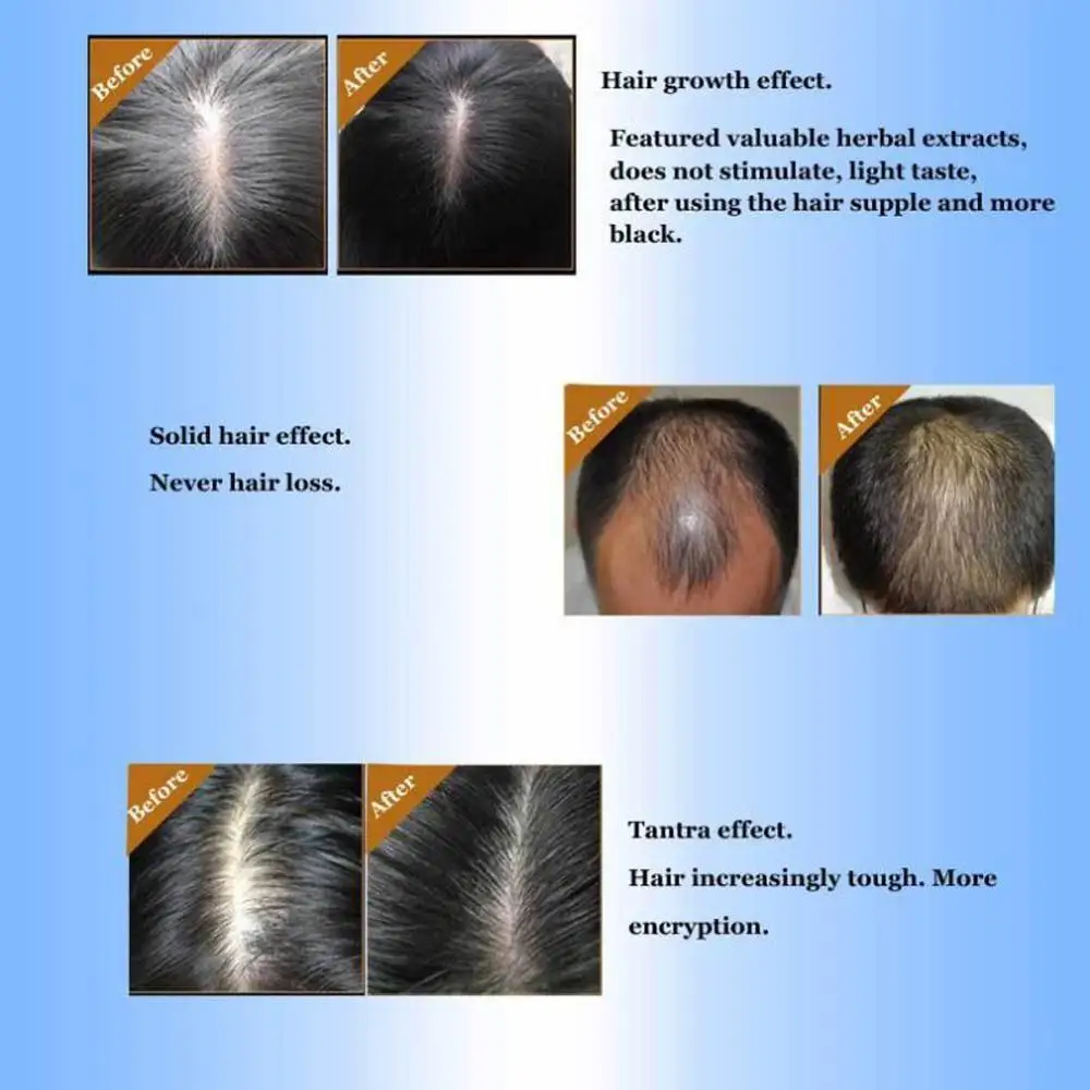 Имбирь Andrea масло для роста волос быстро расти густое восстановление против выпадения волос продукт Sunburst алопеция для женщин и мужчин