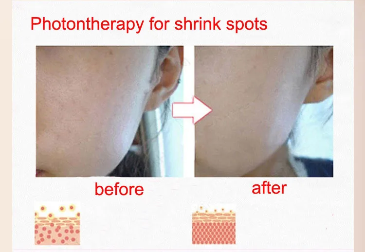 shrink spots