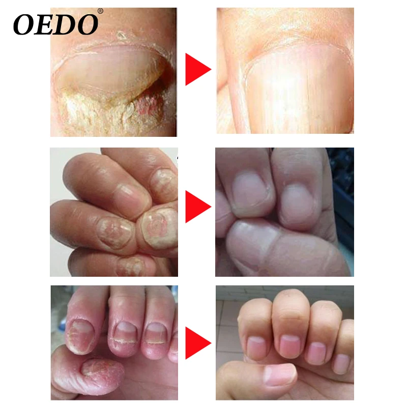 OEDO Herbal Fungal Nail Treatment Essential oil Hand and Foot Whitening Toe Nail Fungus Removal Infection Feet Care TSLM2