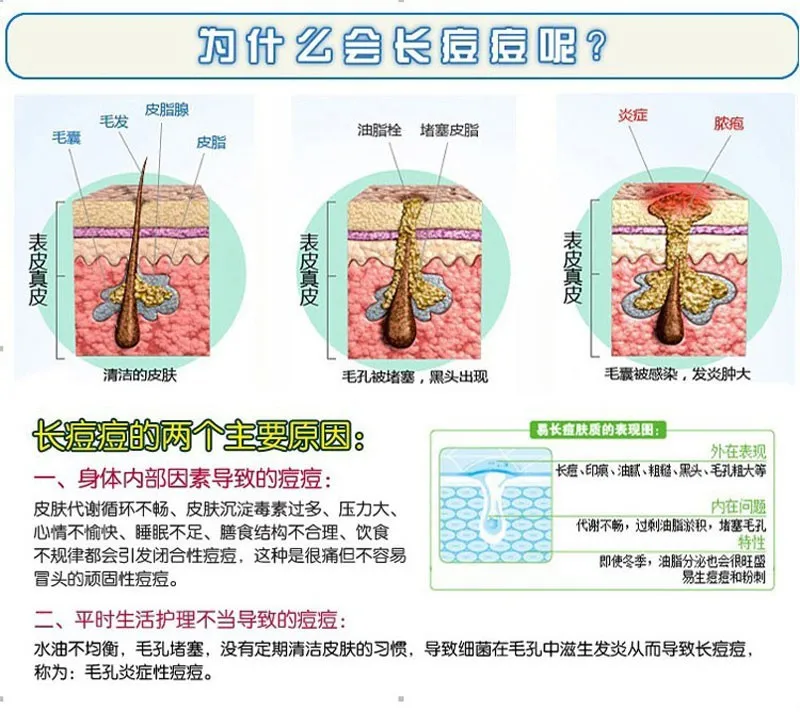 2 шт./партия Nuobisong Лица Шрама страт Gravidarum пигментация корректор Anti-Aging cremas(1+ 1 = 2 шт