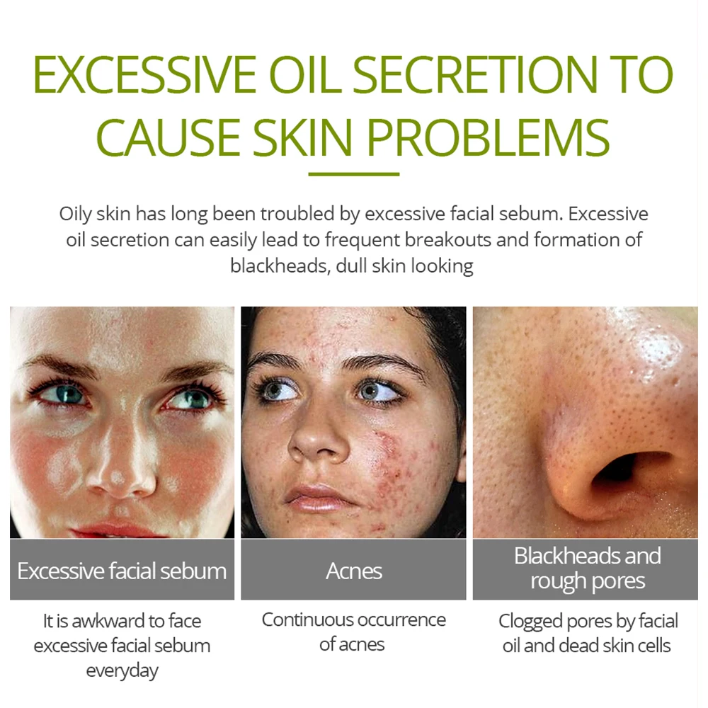 VIBRANT GLAMOUR Tea Tree Acne Face Cream Treatment Acne Scar Shrink Pores Oil Control Facial Skin Care Whitening Moisturizing