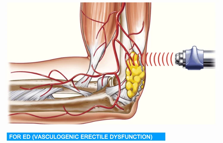 Хороший продукт! Прибор терапией волны удара машины обработки внешний для обработки ED эректильной дисфункции