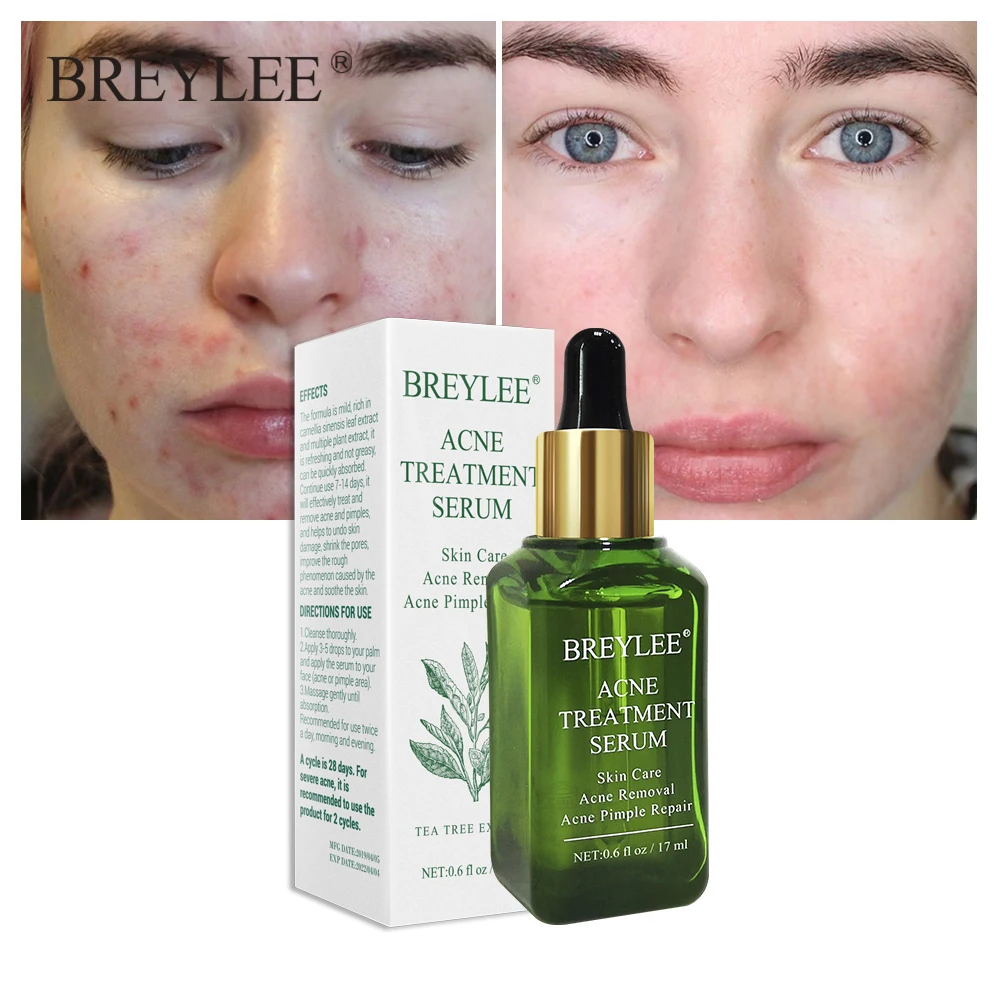 

BREYLEE Acne Treatment Serum Essence Anti Acne Scar Removal Cream Whitening Repair Pimple Remover Acne Face Facial Skin Care