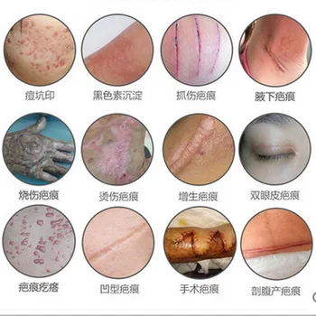 

scar repair Lavender extract against black dots cream scar removal facial blackhead acne skin treatment Stretch Marks Remove