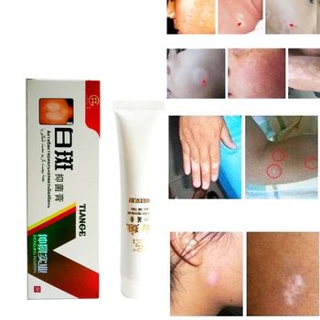 

30g Chinese Medical White Spot Disease Cream Pigment Melanin Promoting Liniment Skin Vitiligo Leukoplakia Disease Treatment D184