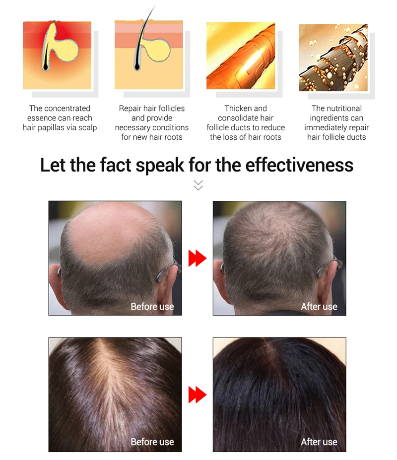 Fortalecer o Cabelo Unissex Calvície Anti Queda Cabelo Crescimento Soro Spray Shampoo Alopecia Tratamento 5 Cheap Prod. perda cab. masc.