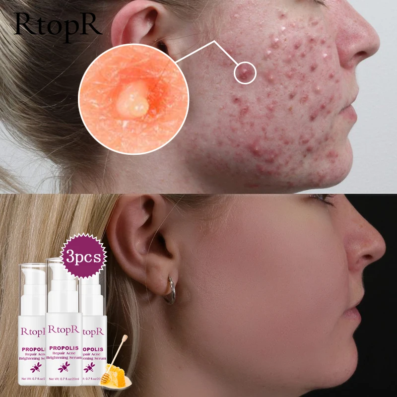

RtopR Acne Brightening Essence Acne Scar Repair Moisturizing Serum Shrinkage Elimination Acne Treatment Propolis Oil Control 3ps