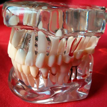 

Study teeth model dental activity pathological model teeth can be removable