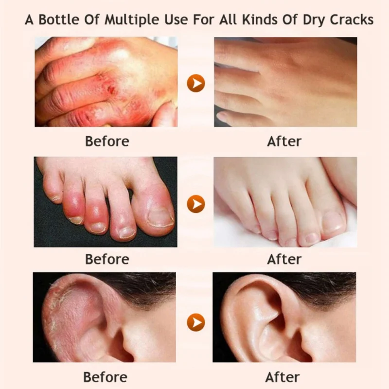 Horse Oil Foot Hand Antifreeze Cream Treatment Dry Skin Heel Chapped Peeling Repair Beauty Skin Care Products