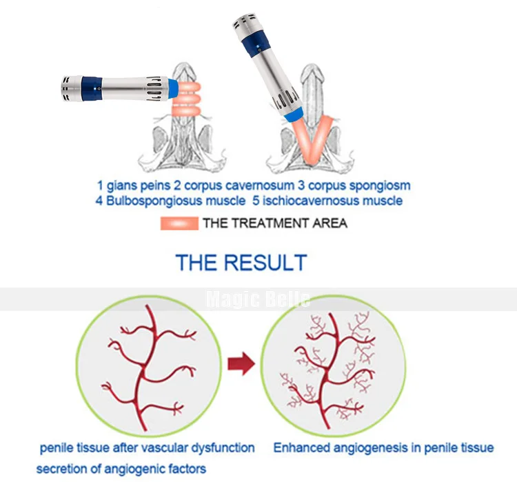 Портативная машина eswt shockwave exterorporeal shock wave устройство мужской эрекции дисфункции оборудование