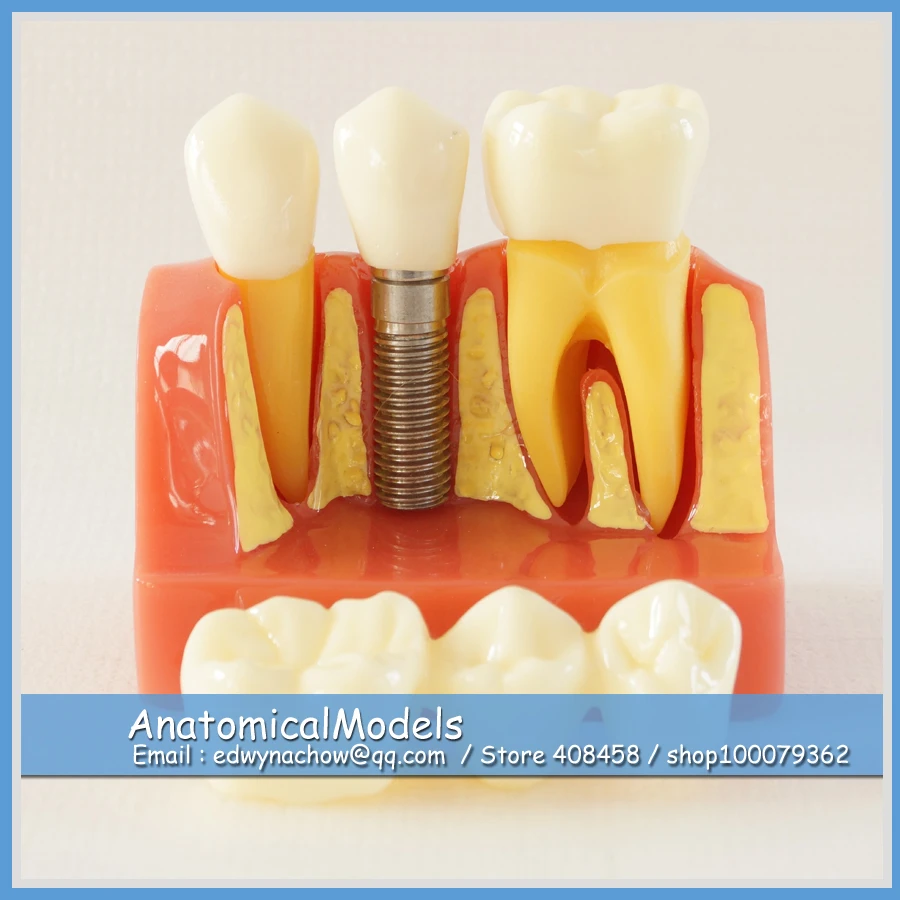 

13145 DH1303 Enlarged 4x Removable Parts Tooth Implant Model , Medical Science Educational Dental Teaching Models
