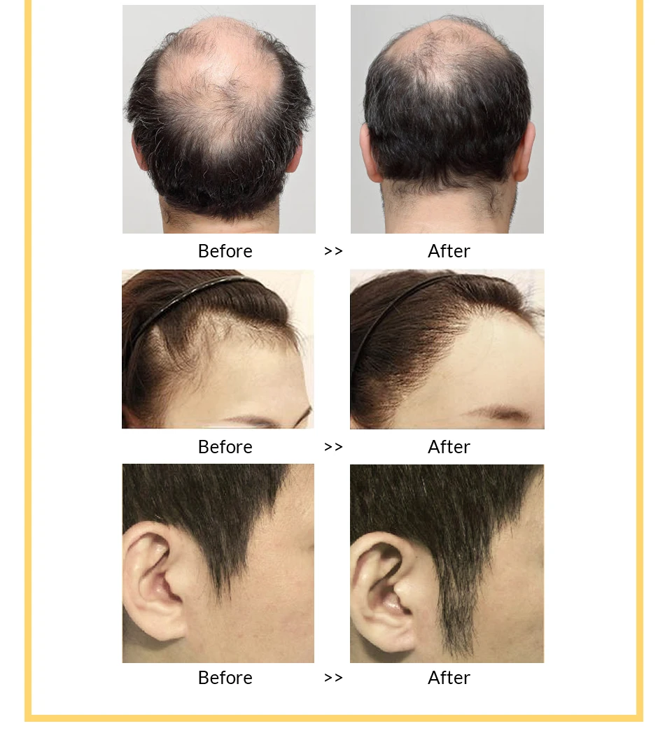 OMY LADY Hair Growth Spray Anti Hair Loss Essential Fast Regrowth Prevent Hair Damaged Thinning Repair Care Scalp Treatment 60ml