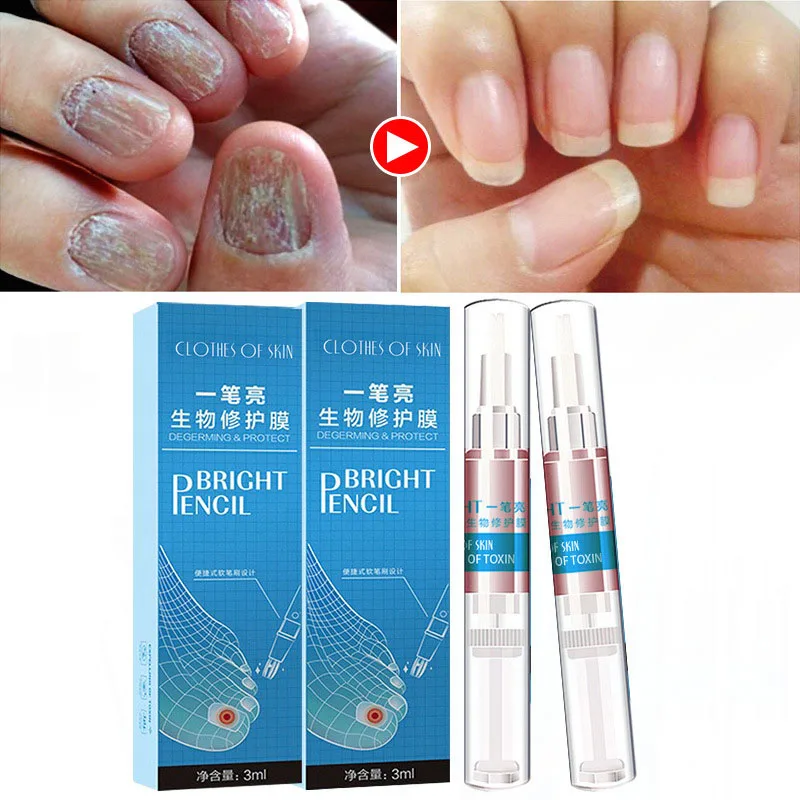 

Fungal Nail Treatment Remuver Cuticle Oil Pen Gel Remedy For Nails Fungus Liquid Care Hand Feet Herbal Essence Anti Infection D