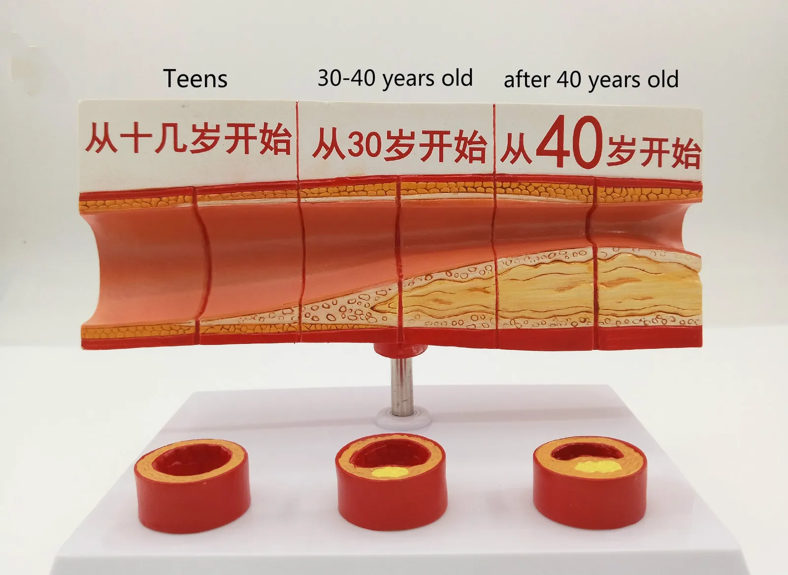 Different Age Blood Vessel Anatomical Model Vascular Atherosclerosis
