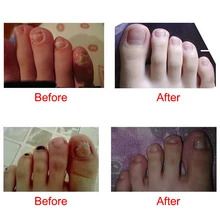 Ножной носок для ногтей удаляет грибок жидкая эссенция увлажняющий Восстанавливающий уход за очисткой TY99