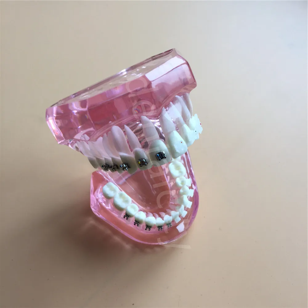 Стоматологический ортодонтический модель с металлической и керамические кронштейны Стоматологическое обследование зубов розовый 3003 Сумки из натуральной кожи