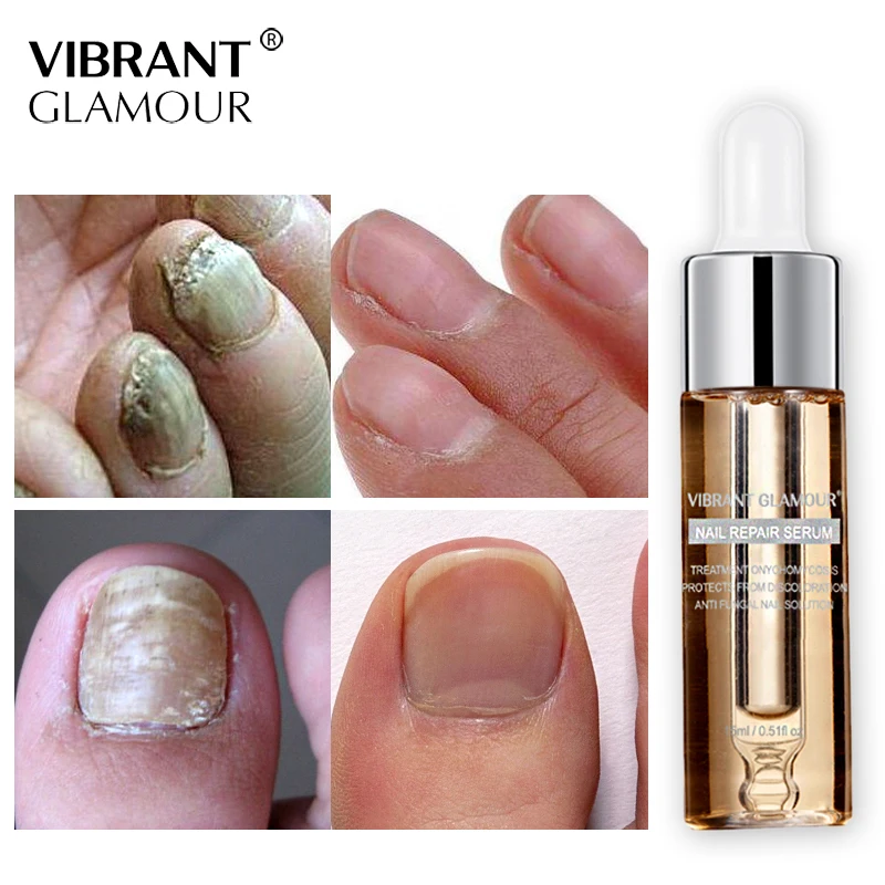 

VIBRANT GLAMOUR Nail Repair Serum Nail Treatment Essence Fungus Onychomycosis Removal Anti Fungus Nail Toe Nourishing Nail Care