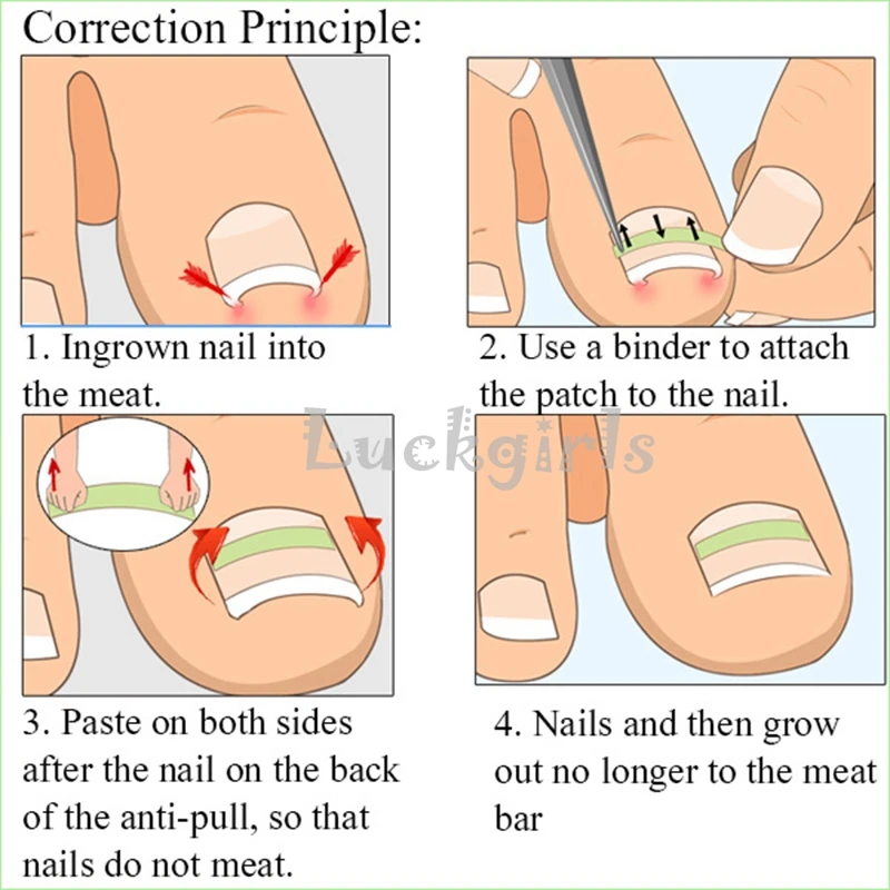 12pcs Bottle Ingrown Toenail Correction Tool Kit 12pcs Bottle Ingrown Toenail Correction Tool Kit Pedicure Straightening Clip Curved Bs Brace With Glue In Foot Care From Beauty