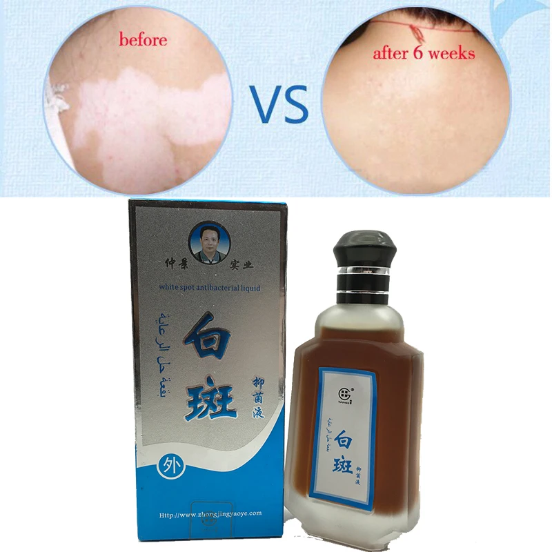 80ml Professional White Spot Antibacterial Liquid Chinese Medicine Care Solution Skin Vitiligo font b Treatment b