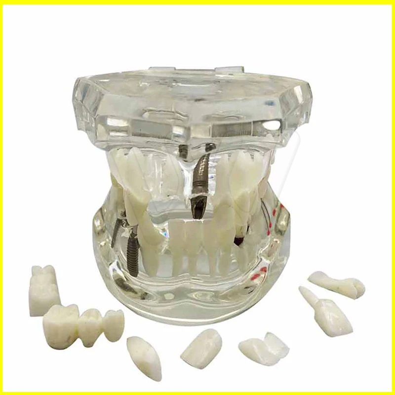 

Dental implant Demonstration Bracket Simulation Teeth Model teeth removable