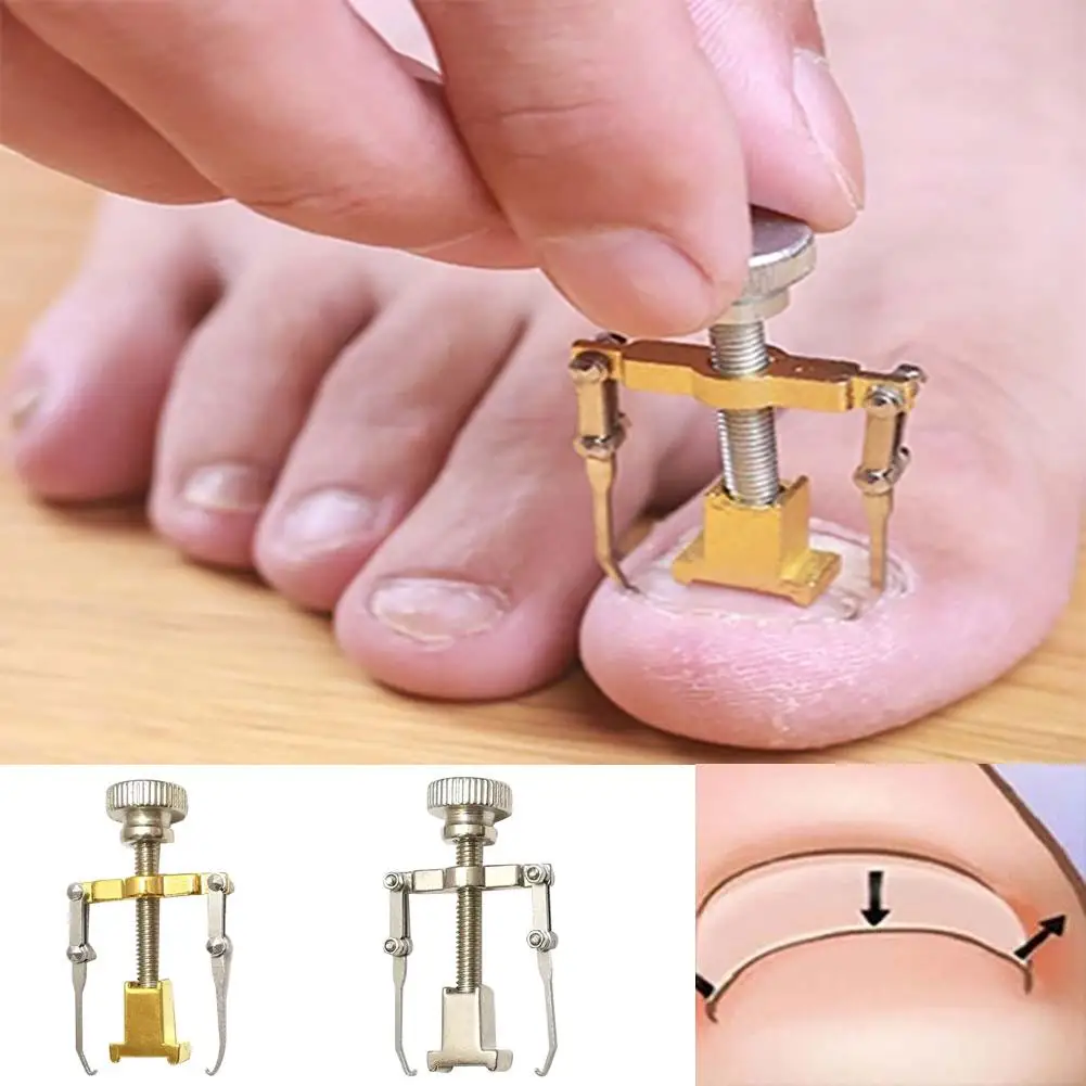 

Ingrown Toenail Toe Fixer Recover Correction Device Pedicure Foot Nail Care Tool convenience
