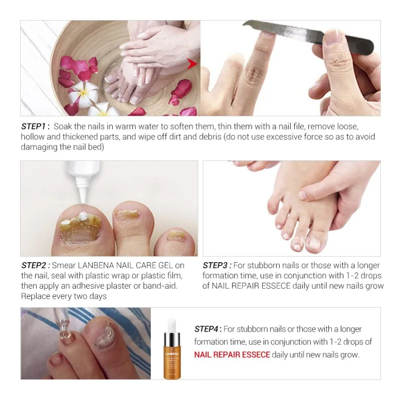Effective Onychomycosis Paronychia Fungus Infection Repair Solution Gel Fingernails Toenails Care Nail Treatment Pen
