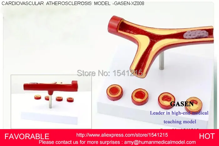 

HUMAN ANATOMICAL VASCULAR ATHEROSCLEROSIS PATHOLOGY MEDICAL ORGAN TEACH MODEL ,HEMATOLOGY VESSEL MODEL-GASEN-XZ008