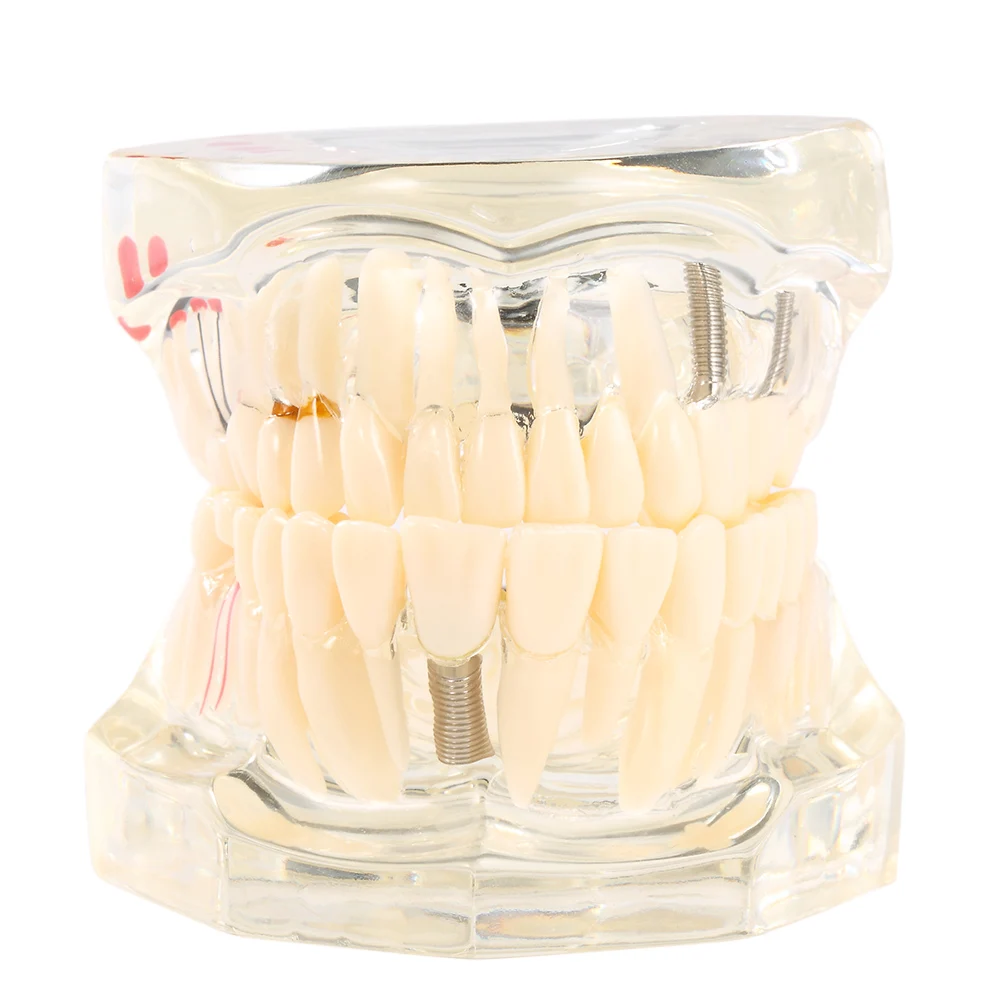 

Transparent Dental Implantation Disease Tooth Dentist Teaching Teeth Tool Dental Adult Typodont Removable Teeth Model Tools