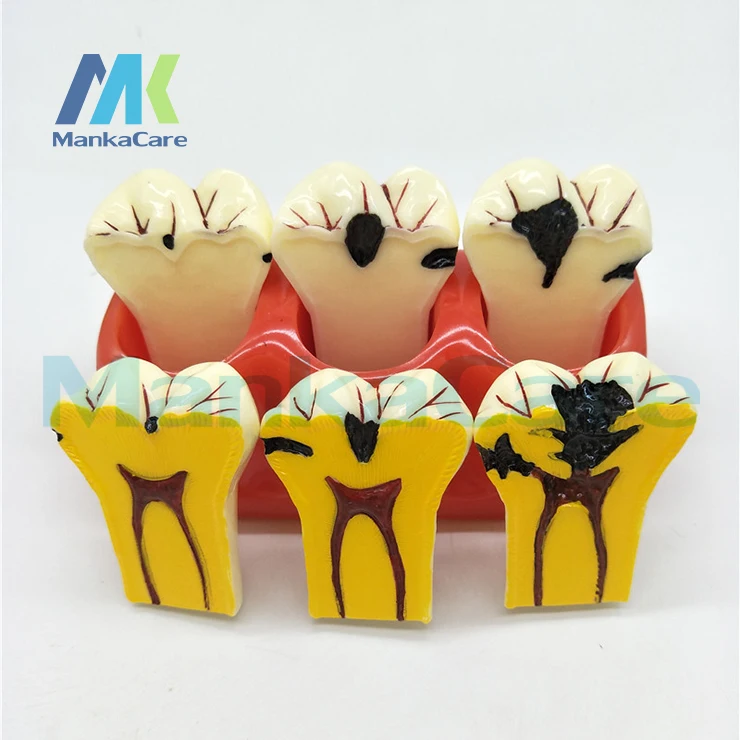 

1 pc Dental Materials Lab 4 Times Caries Disassembling Model Denture Disease Teeth Model For Dentist Clinic