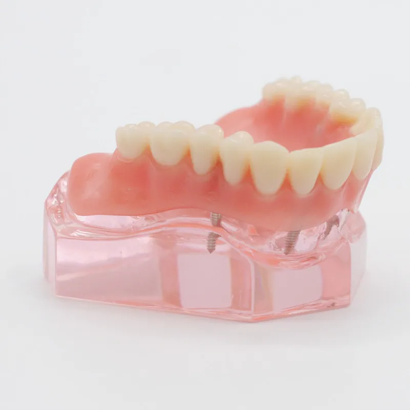 Dentist Overdenture Upper Anterior Maxillary 4 Implants Restoration Teeth Model For Dentistry Lab | Красота и здоровье