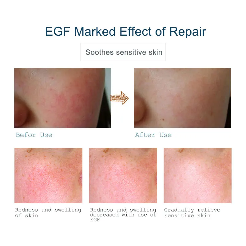 Отбеливающая увлажняющая сыворотка ARTISCARE EGF 3 шт. средство для лечения черных