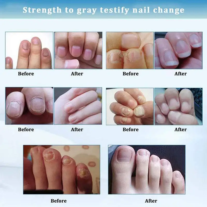 Toenail Fungus Treatment Toenail Antifungal Care Nail Fungus Treatment Pen Fungal Nail Gel Toenail Fungus Treatment Toenail Antifungal Care Nail Fungus Treatment Pen Fungal Nail Gel