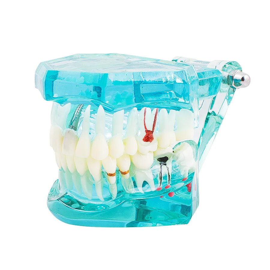 Стоматологическая Студенческая Стоматологическая Исследование Зуб Прозрачный взрослый патологические зубы модель подходит для взрослых
