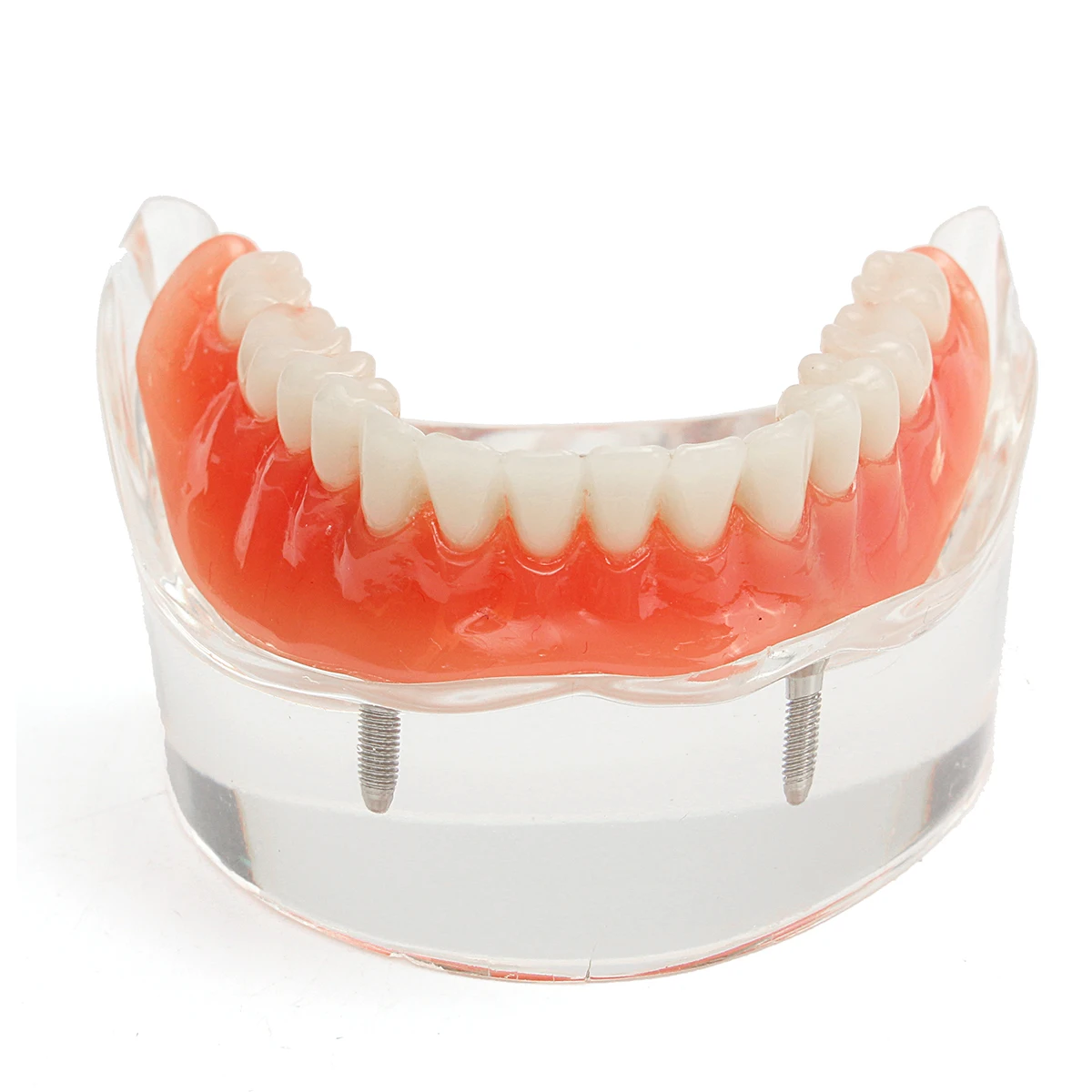 

Lower Teeth Model Mandibular With Implant Restoration Tooth Dental Overdenture Interior Mandibular for Medical Teaching Study
