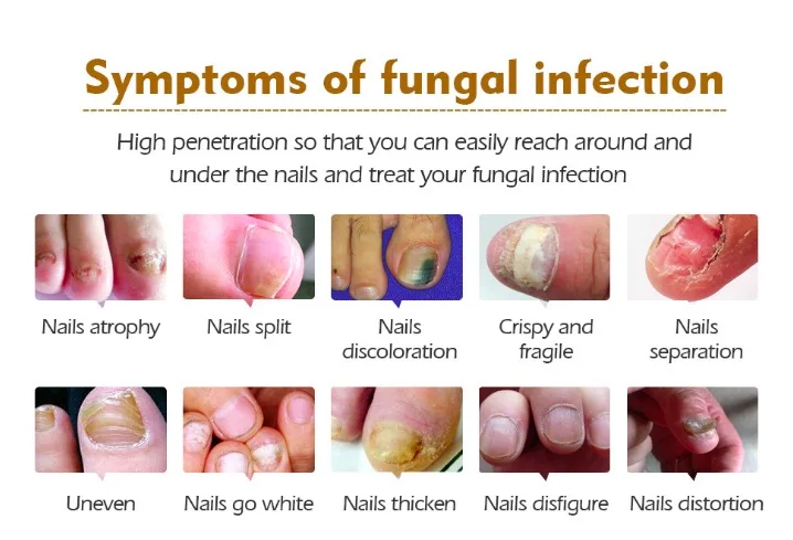Лечение ногтей от грибка Уход за ногами отбеливающая эссенция ног удаление грибка гель анти-инфекция Onychomycosis ногтей восстанавливающая эссенция